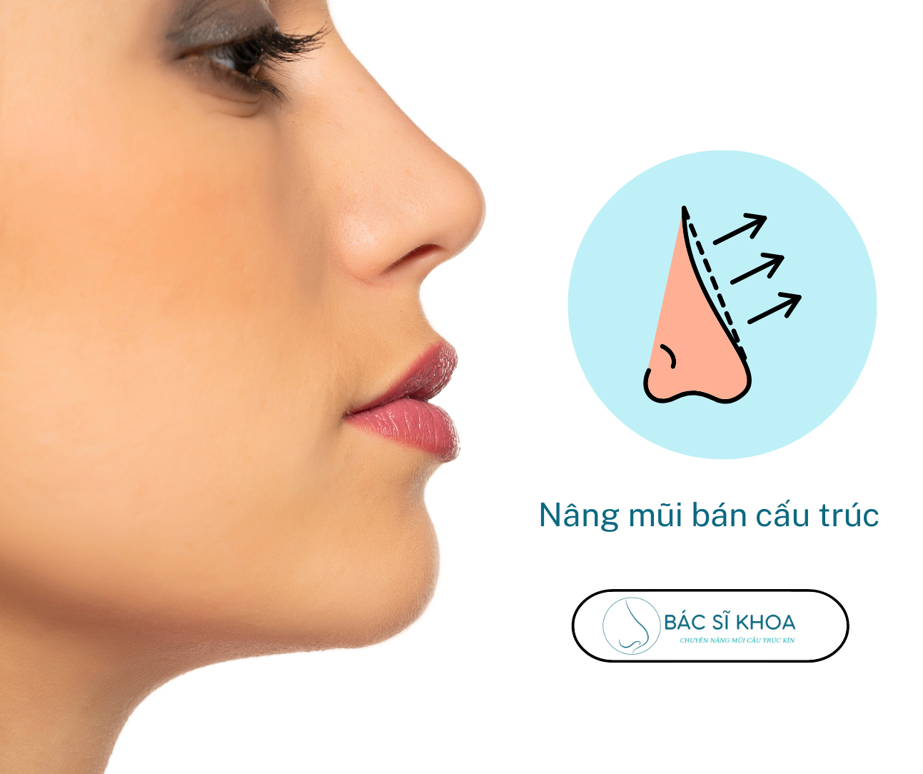 Nâng mũi bán cấu trúc tại bác sĩ Đăng Khoa