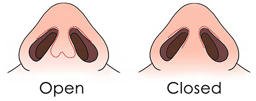 sự khác giữa nâng mũi cấu trúc kín và cấu trúc hở