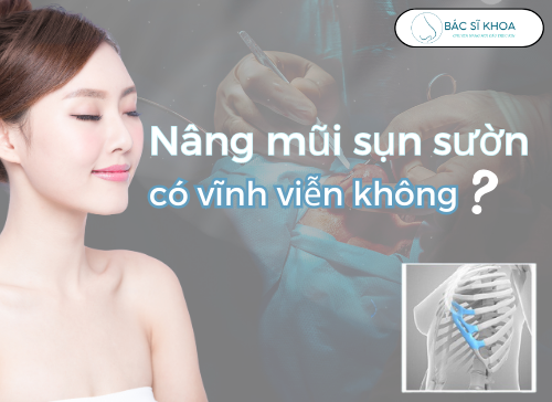 nâng mũi sụn sườn có vĩnh viễn không