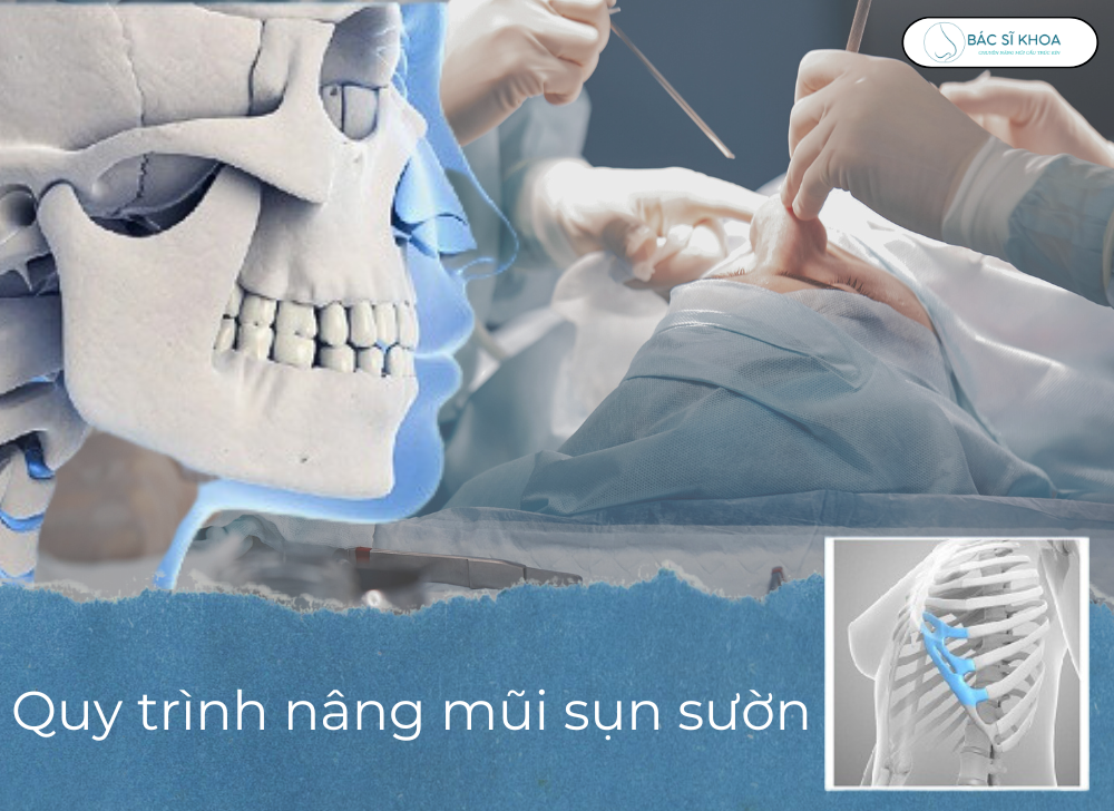 Quy trình nâng mũi bằng sụn sườn